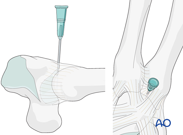 Marking the 5th carpometacarpal joint with a hypodermic needle