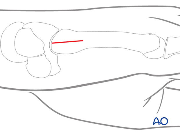 Dorsoulnar approach to the 5th metacarpal base