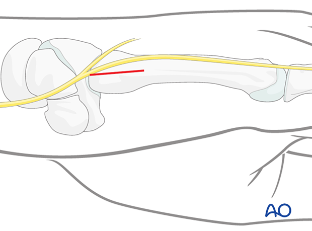 Skin incision of a dorsoulnar approach to the 5th metacarpal base