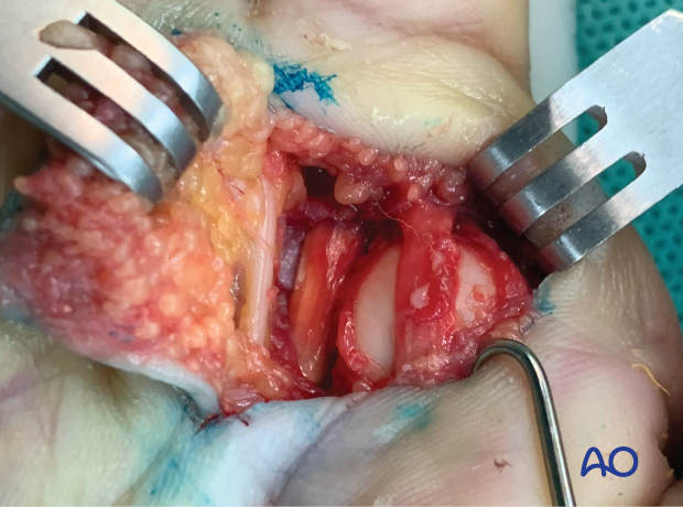 Approach to the 2nd metacarpal head with volar dislocation of the digital nerve