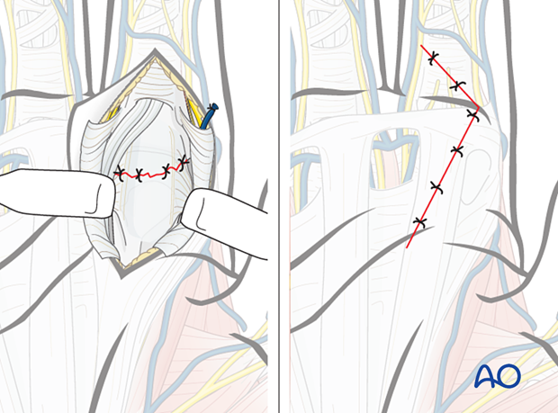 Joint capsule and skin closure after a volar approach to the metacarpophalangeal joint