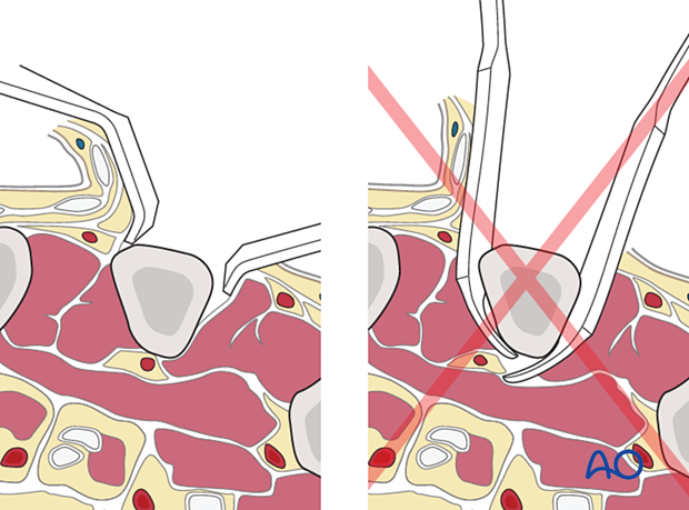 Use of Langenbeck retractors instead of Hohmann levers to avoid complete muscle detachment during a radial approach to the 2nd metacarpal