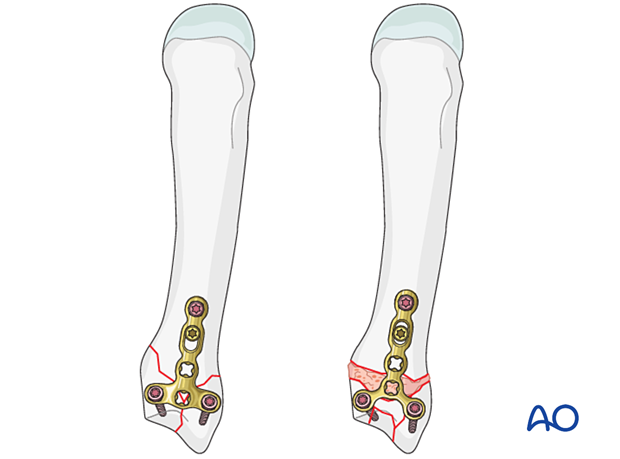 Plating of a complete articular fracture of the metacarpal base