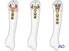 Plating of a complete articular fracture of a metacarpal head