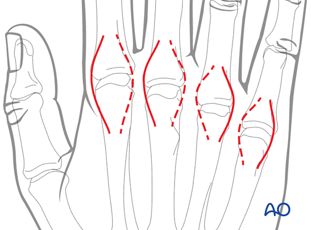 Dorsal approach to the metacarpophalangeal joints