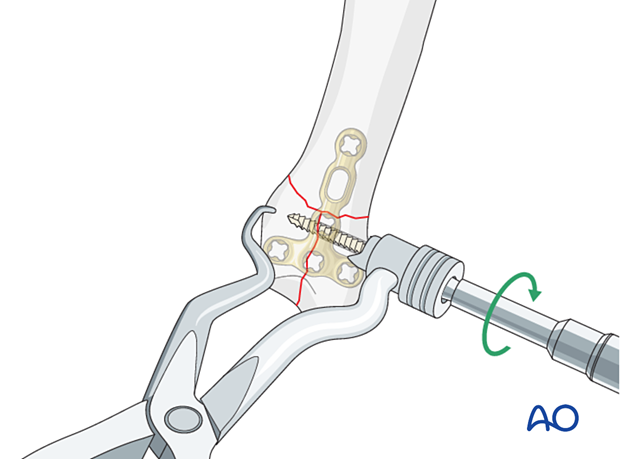 Reduction and fixation of the articular block in a simple T- and Y-shaped fracture of the 5th metacarpal base with a lag screw