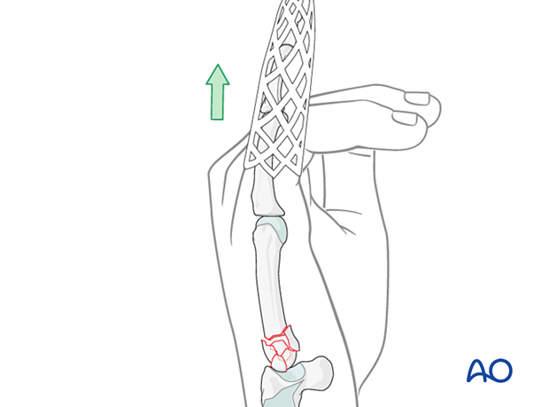 Traction of the 5th finger for restoring length of a complete articular fracture of the 5th metacarpal base