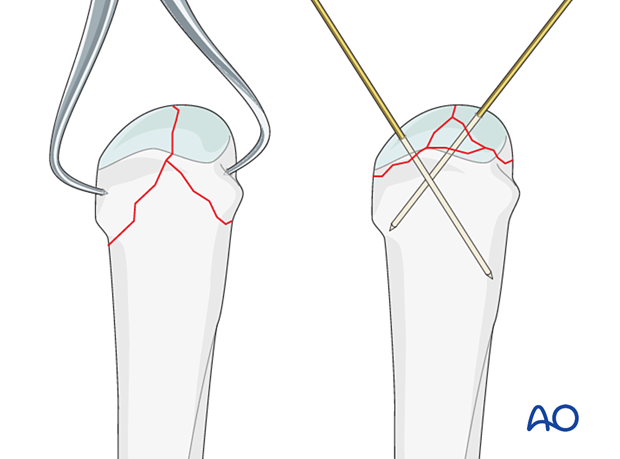 Reduction of a complete articular fracture of a metacarpal head