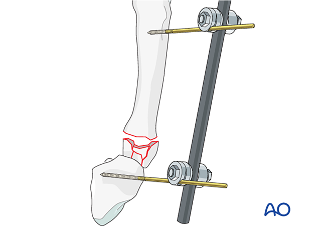 Application of an external fixator to the 5th metacarpal and hamate for restoring length of a complete articular fracture of the 5th metacarpal base