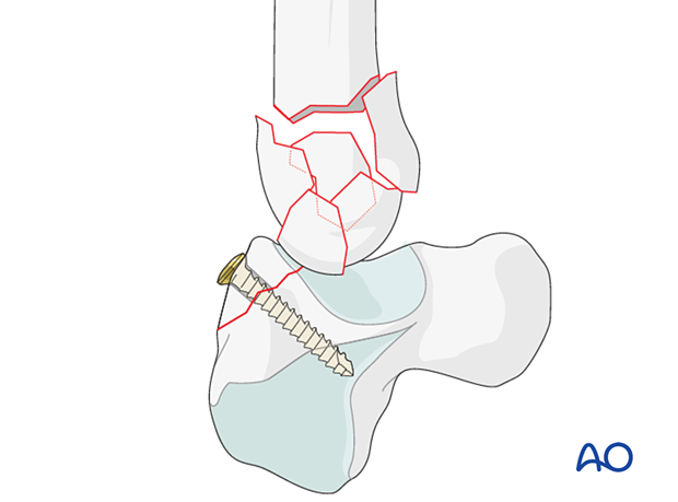 Screw fixation of a shearing fracture of the hamate associated with a complete articular fracture of the 5th metacarpal base