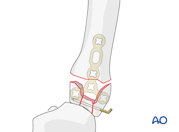 Stabilization of the articular fragments in a complete articular fracture of the 5th metacarpal base with a K-wire