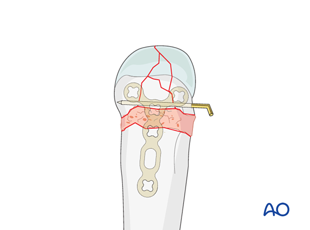 Stabilization of the articular fragments in a complete articular fracture of a metacarpal head with a K-wire and added cancellous autograft