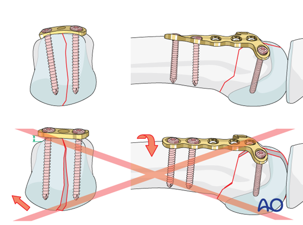 Contouring the plate exactly to the bone surface to achieve compression across the whole fracture plane