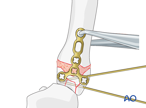 Application of a T-plate for stabilization of a complete articular fracture of the 5th metacarpal base