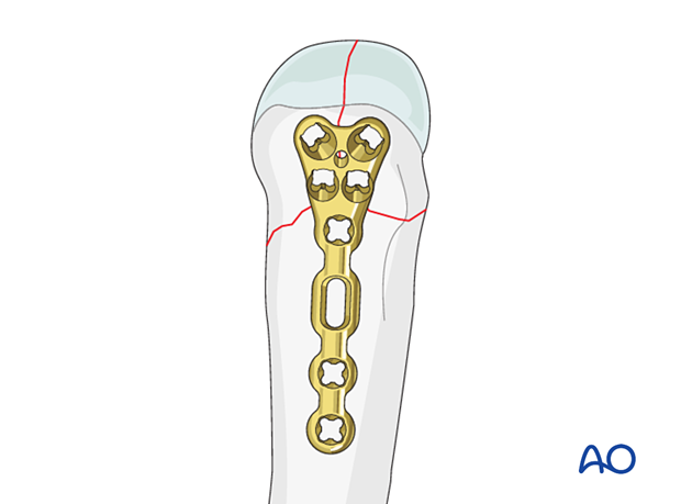 Application of a metacarpal neck plate for stabilization of a complete articular fracture of a metacarpal head