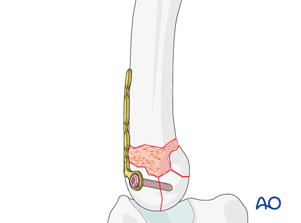 T-plate fixation of a complete articular fracture of a metacarpal base - Insertion of a screw through the plate into the articular block