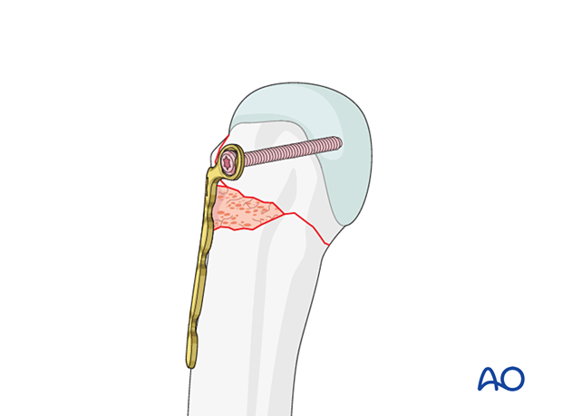 T-plate fixation of a complete articular fracture of a metacarpal head - Insertion of a screw through the plate into the articular block