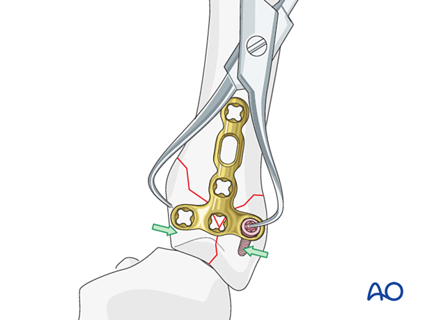 T-plate fixation of a complete articular fracture of a metacarpal base – Extrinsic compression of the simple articular fracture 