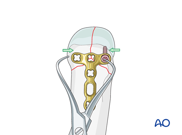 T-plate fixation of a complete articular fracture of a metacarpal head – Extrinsic compression of the simple articular fracture 