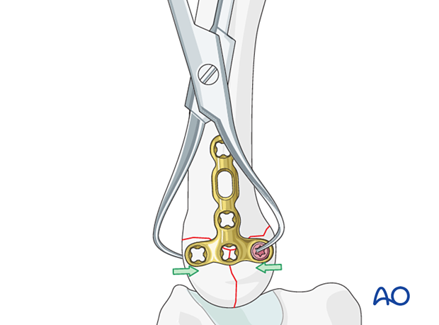 T-plate fixation of a complete articular fracture of a metacarpal base – Extrinsic compression of the simple articular fracture of the 5th metacarpal base