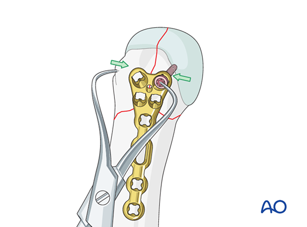 T-plate fixation of a complete articular fracture of a metacarpal head – Extrinsic compression of the simple articular fracture of the 5th metacarpal head