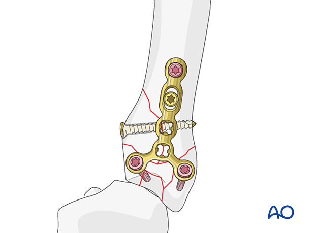 T-plate and screw fixation of a complete articular fracture of a metacarpal head