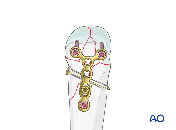 T-plate and screw fixation of a complete articular fracture of a metacarpal head