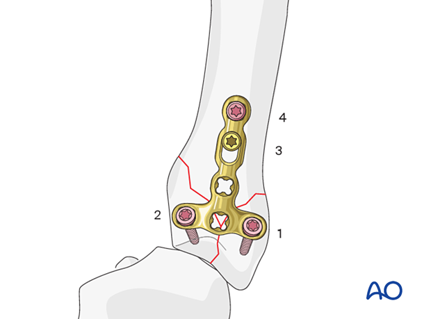 T-plate fixation of a simple complete articular fracture of a metacarpal base