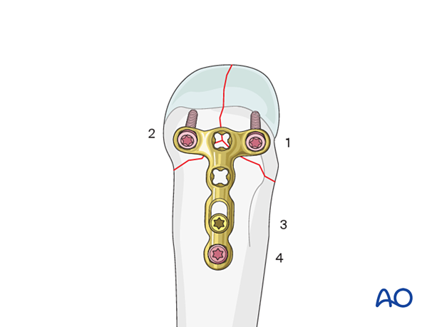 T-plate fixation of a simple complete articular fracture of a metacarpal head