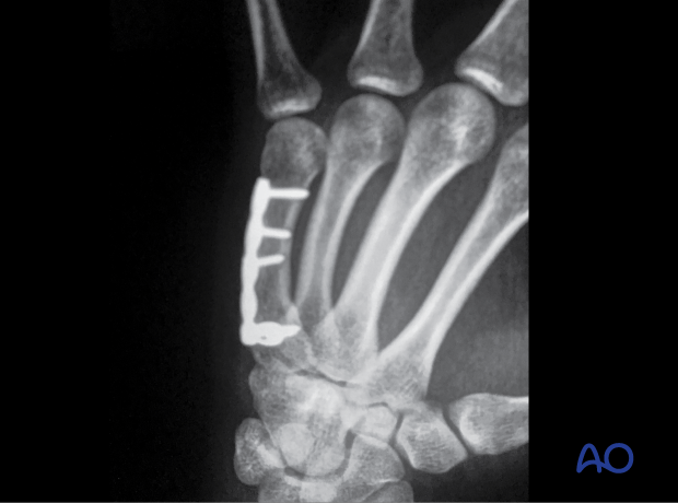 AP x-ray of a complete articular fracture of the 5th metacarpal base stabilized with a plate