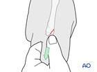 Manual reducion of a partial articular fracture of a metacarpal head