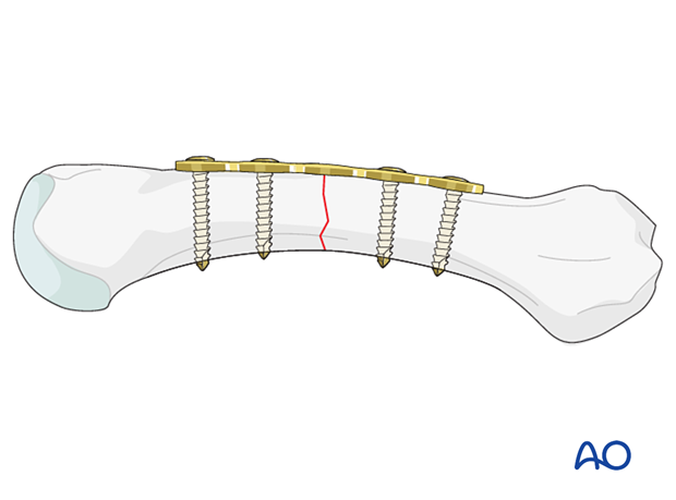 Compression plating of a transverse metacarpal shaft fracture