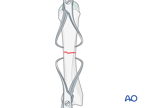 Application of pointed reduction forceps to reduce and hold a metacarpal shaft fracture