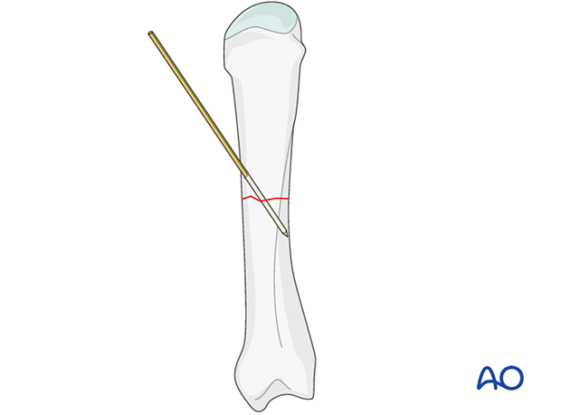 K-wire inserted to provisionally hold reduction of a metacarpal shaft fracture