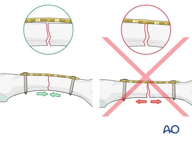 Overbending the plate relative to the bone surface results in compression across the whole fracture plane