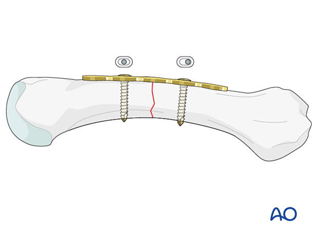 Application of a compression plate to a transverse metacarpal fracture