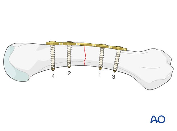 Order of screw insertion for compression plating of a transverse metacarpal shaft fracture 