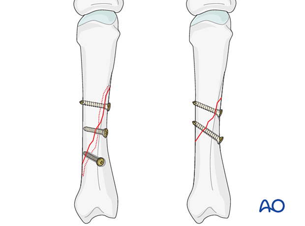 Lag-screw fixation with two or more screws of long oblique and spiral metacarpal fracture