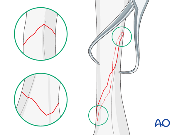 Application of pointed reduction forceps to reduce and hold an oblique metacarpal fracture