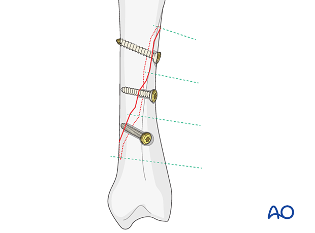 Fixation of an oblique metacarpal fracture with three lag screws