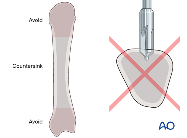 Countersinking should be avoided in the metaphysis of the metacarpal.