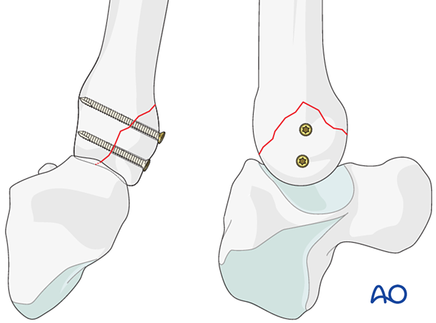 Lag-screw fixation with two screws of a partial articular fracture of the metacarpal base