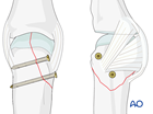 Lag-screw fixation of a partial articular fracture of a metacarpal head