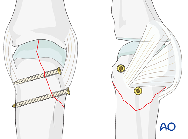 Lag-screw fixation with two screws of a partial articular fracture of the metacarpal head