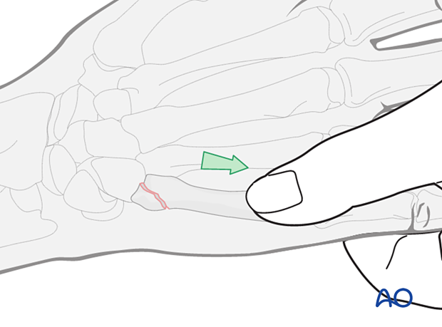 Closed reduction of a partial articular fracture of the 5th metacarpal base