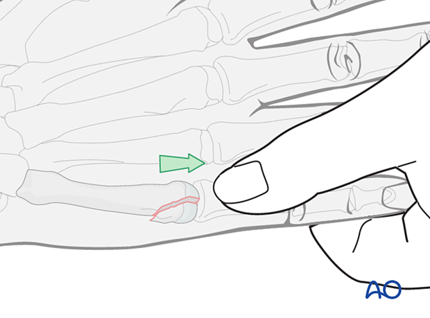 Closed reduction of a partial articular fracture of the 5th metacarpal head