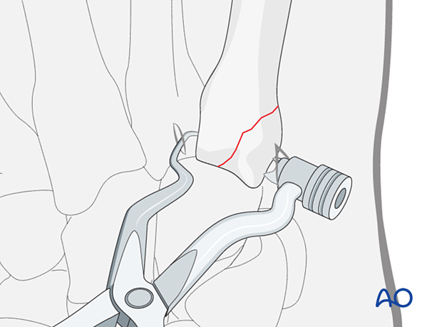 Holding the closed reduction of a partial articular fracture of the metacarpal base with reduction forceps