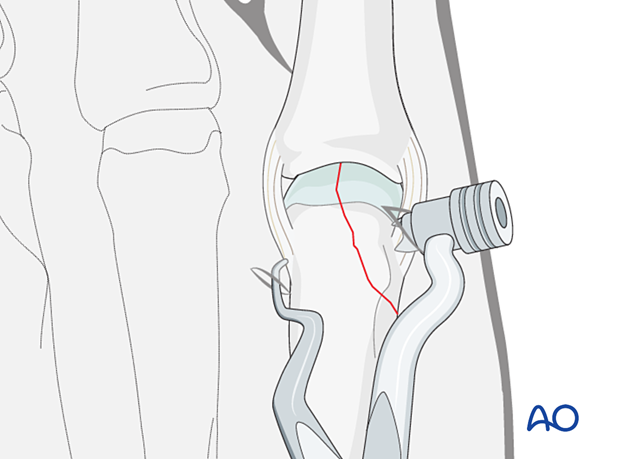 Holding the closed reduction of a partial articular fracture of the metacarpal base with reduction forceps