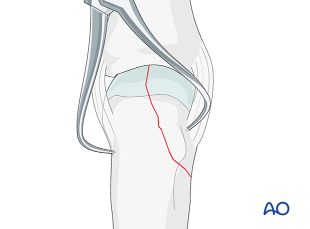 Holding the reduction of a partial articular fracture of the metacarpal base with reduction forceps