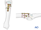 Lag-screw fixation with a neutralization plate of a partial articular fracture of a metacarpal head